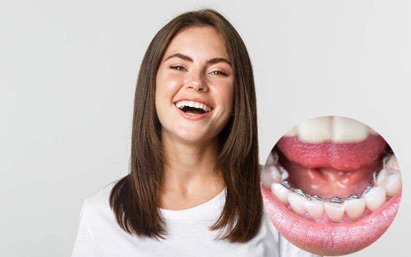  Những lý do nên và không nên lựa chọn niềng răng mắc cài trong lưỡi