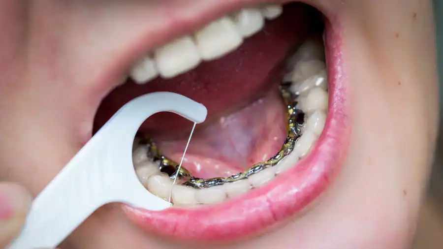 Niềng răng mắc cài trong lưỡi gây khó khăn trong việc vệ sinh răng miệng